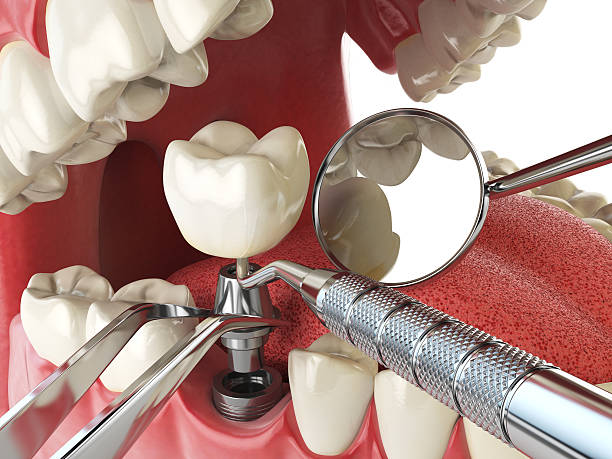 Best Emergency Tooth Extraction in Vista Santa Rosa, CA